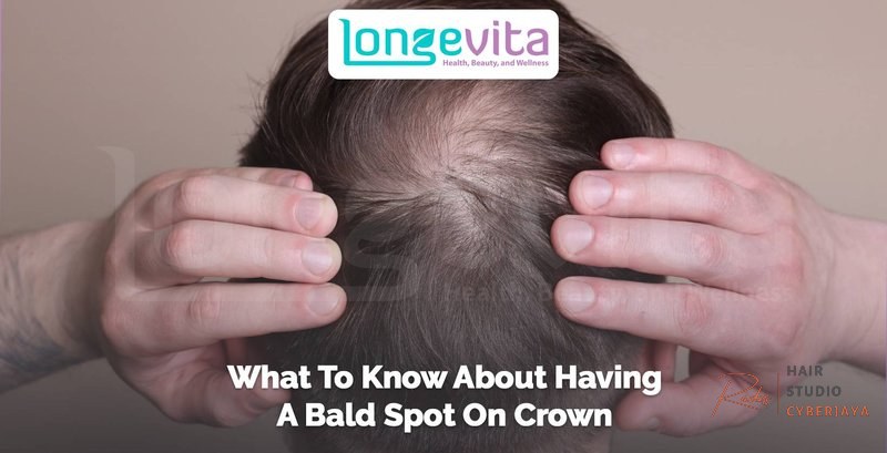 Bald Spot On Crown: How It Looks, Causes & Treatments Bald Spot On Crown: How It Looks, Causes & Treatments