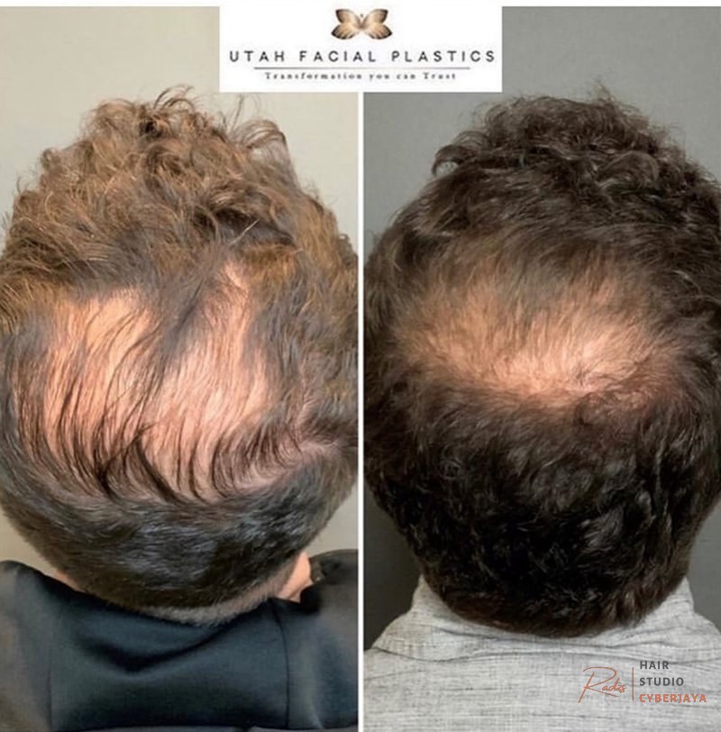 Balding Crown: How To Spot It - Hair Restoration Balding Crown: How To Spot It - Hair Restoration