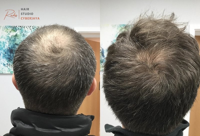 Crown Balding: Causes, Early Signs and Effective Treatments Crown Balding: Causes, Early Signs and Effective Treatments
