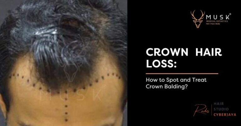 Crown Hair Loss: How to Spot and Treat Crown Balding