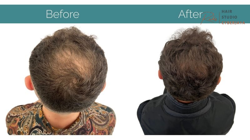 Everything You Need to Know About Crown Balding Everything You Need to Know About Crown Balding