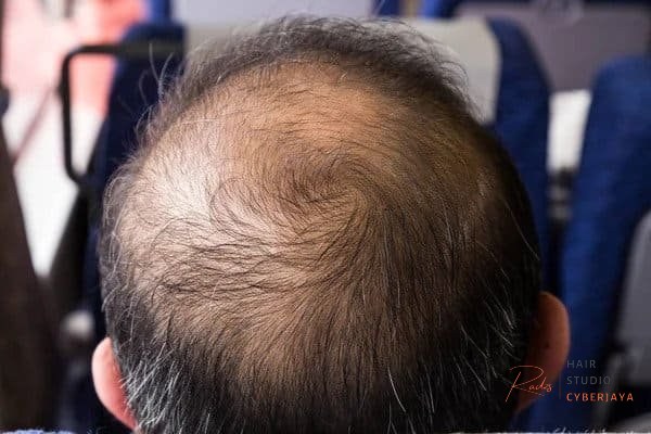 How to Spot and Stop Balding on Crown How to Spot and Stop Balding on Crown