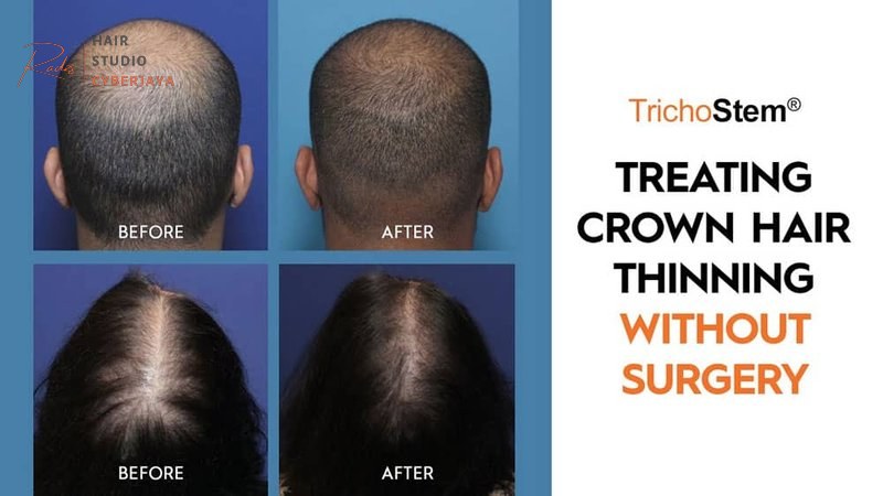 How to Treat Hair Thinning At Crown and Grow Thicker Hair How to Treat Hair Thinning At Crown and Grow Thicker Hair