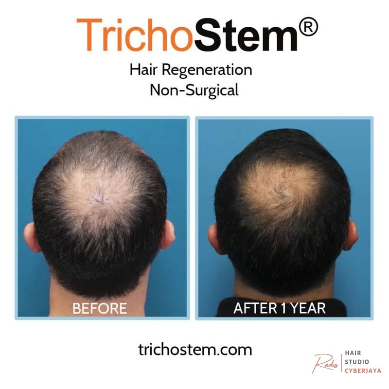 How to Treat Hair Thinning At Crown and Grow Thicker Hair How to Treat Hair Thinning At Crown and Grow Thicker Hair