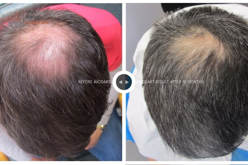 What is Crown Balding, And How Can I Stop It? What is Crown Balding, And How Can I Stop It?