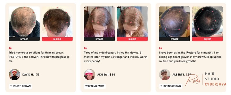 Why Is My Hair Thinning at the Crown? Causes, Early Signs & What to Do Why Is My Hair Thinning at the Crown? Causes, Early Signs & What to Do