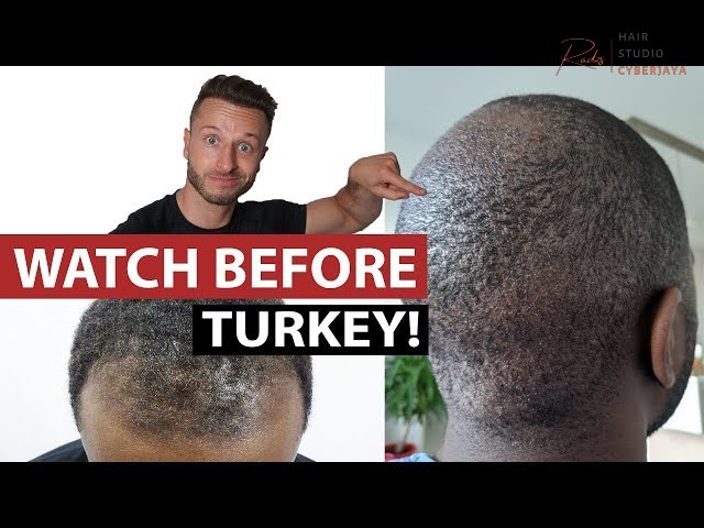 Afro FUE Hair Transplant Turkey - 3 Things to Watch Out For! - YouTube Afro FUE Hair Transplant Turkey - 3 Things to Watch Out For! - YouTube