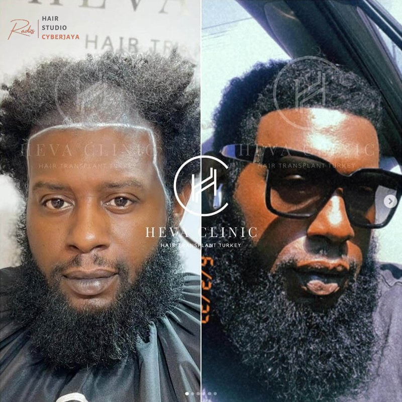 Afro Hair Transplant Before & After Photos - Unfiltered Results Afro Hair Transplant Before & After Photos - Unfiltered Results