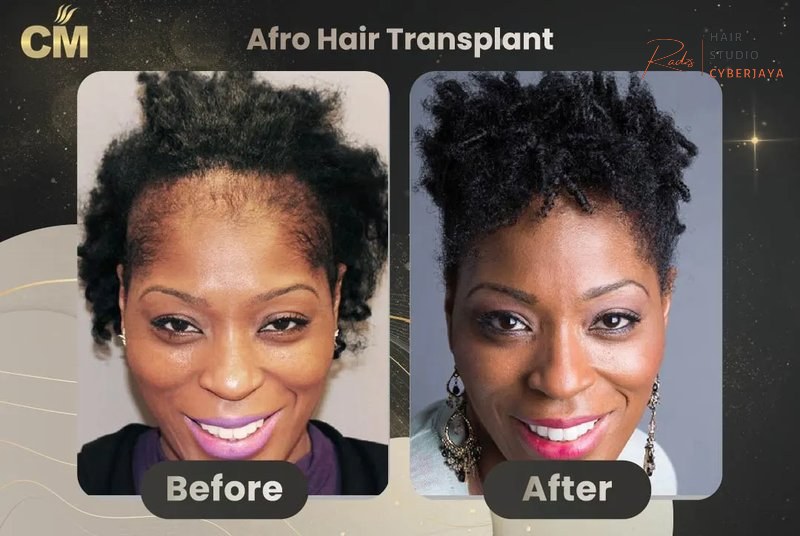 Afro Hair Transplant Before and After | Natural Results-Expert Clinic Afro Hair Transplant Before and After | Natural Results-Expert Clinic
