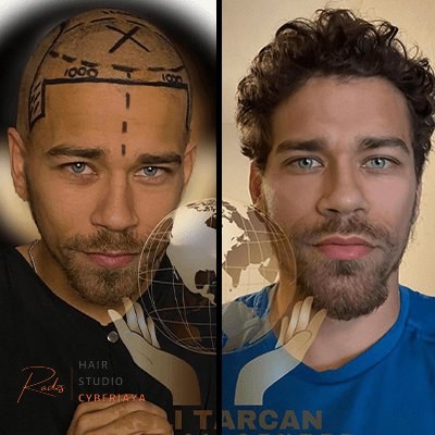 Afro Hair Transplant in Turkey - Asli Tarcan Clinic Afro Hair Transplant in Turkey - Asli Tarcan Clinic