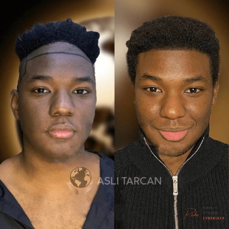Afro Hair Transplant in Turkey - Asli Tarcan Clinic