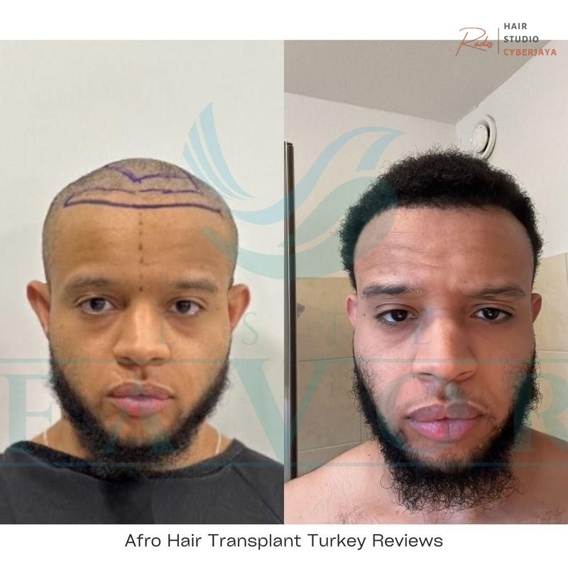 Afro Hair Transplant in Turkey - Best Hair Transplant Clinic in Turkey Afro Hair Transplant in Turkey - Best Hair Transplant Clinic in Turkey