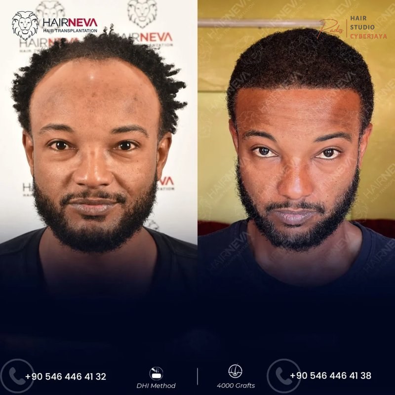 Afro Hair Transplant in Turkey Cost 2026 - Hairneva Afro Hair Transplant in Turkey Cost 2026 - Hairneva