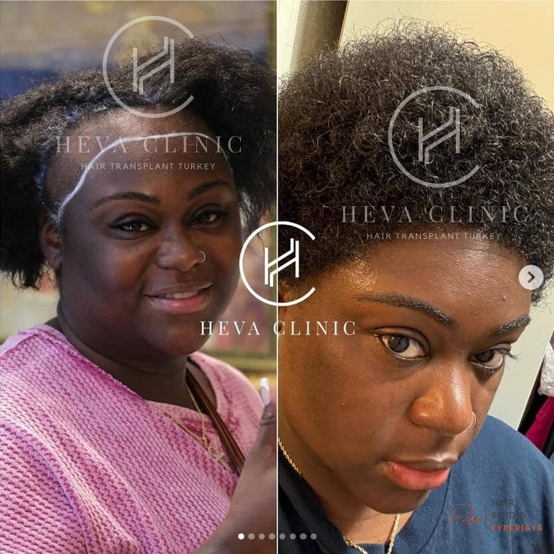 Afro Hair Transplant in Turkey - Procedure & Cost in 2026 - Heva Clinic Afro Hair Transplant in Turkey - Procedure & Cost in 2026 - Heva Clinic