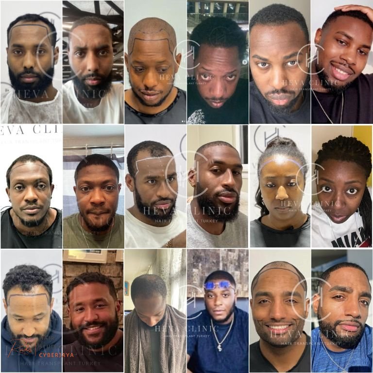 Afro Hair Transplant in Turkey - Procedure & Cost in 2026 - Heva Clinic Afro Hair Transplant in Turkey - Procedure & Cost in 2026 - Heva Clinic