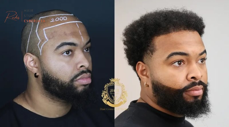 Afro Hair Transplant Turkey (2026 Guide) - Hair Center of Turkey Afro Hair Transplant Turkey (2026 Guide) - Hair Center of Turkey