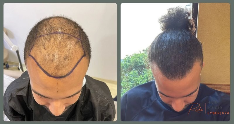 Afro Hair Transplants in Turkey: Unique Challenges & Solutions Afro Hair Transplants in Turkey: Unique Challenges & Solutions