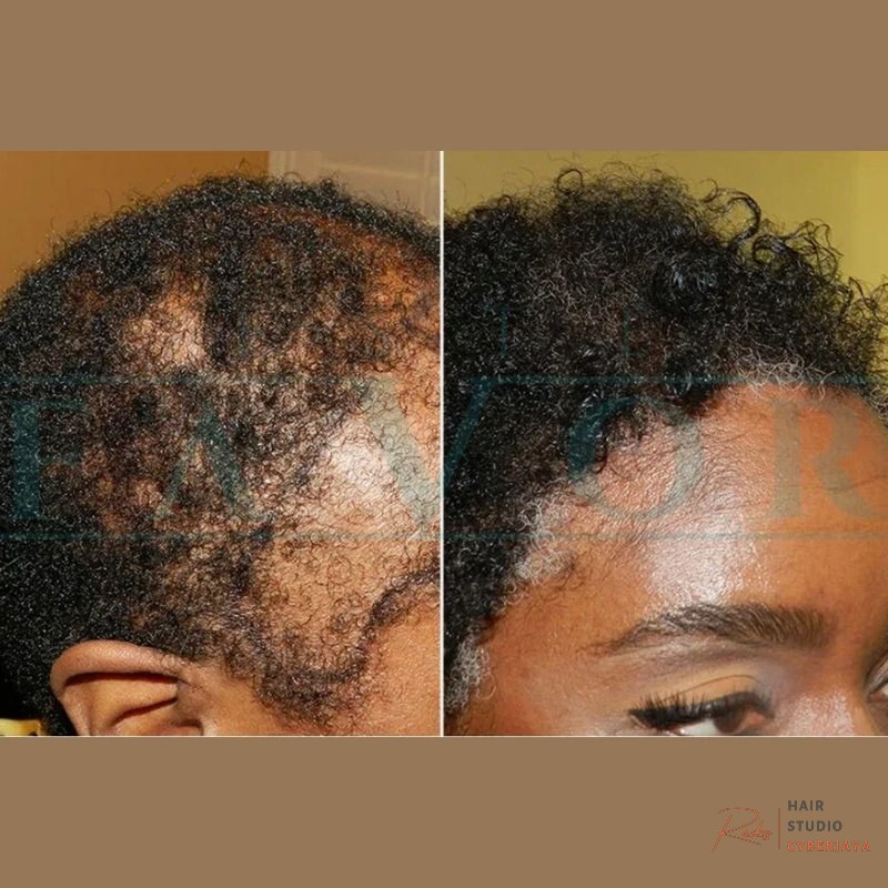 Common Mistakes to Avoid in Afro Hair Transplant in Turkey - Best Hair Transplant Clinic in Turkey Common Mistakes to Avoid in Afro Hair Transplant in Turkey - Best Hair Transplant Clinic in Turkey