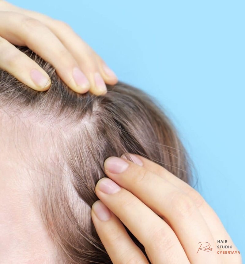 Dermatologist for Hair Loss Treatment in Alpharetta, GA Dermatologist for Hair Loss Treatment in Alpharetta, GA