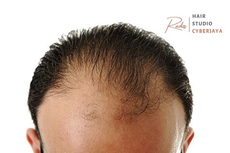 Hair Loss / Alopecia Treatments Near Me Arlington, VA | DC, McLean Hair Loss / Alopecia Treatments Near Me Arlington, VA | DC, McLean