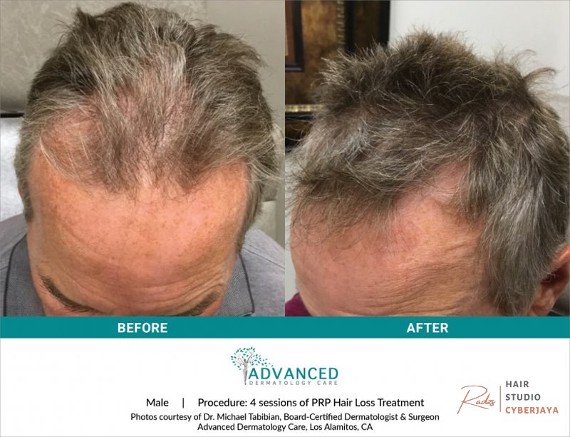 Hair Loss & Scalp Disorders in Los Alamitos & Agoura Hills | Advanced Dermatology Care Hair Loss & Scalp Disorders in Los Alamitos & Agoura Hills | Advanced Dermatology Care