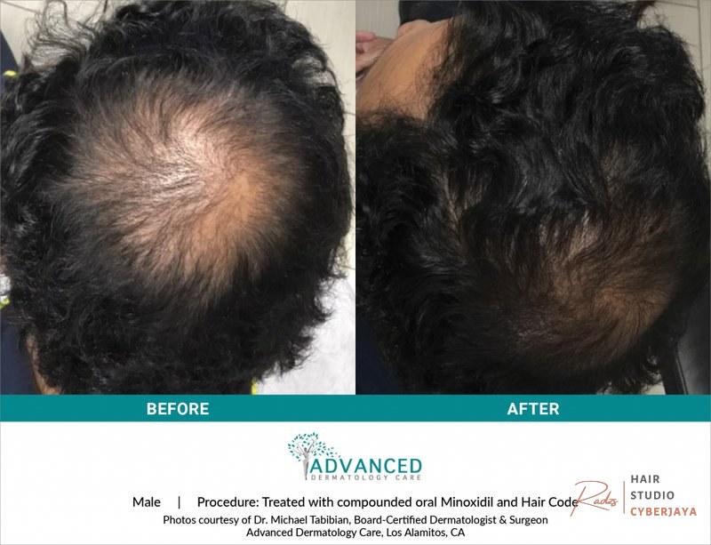 Hair Loss & Scalp Disorders in Los Alamitos & Agoura Hills | Advanced Dermatology Care Hair Loss & Scalp Disorders in Los Alamitos & Agoura Hills | Advanced Dermatology Care