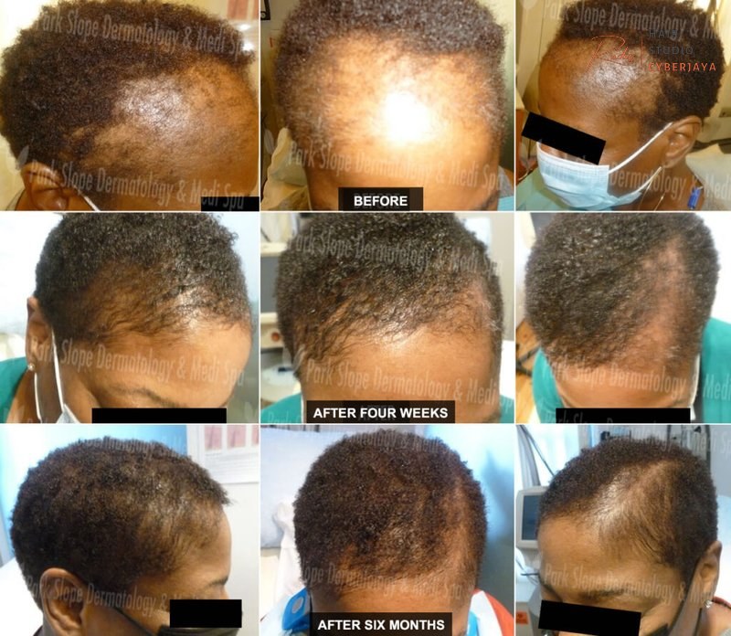 Hair Loss Specialist Brooklyn & NYC – Regrow Your Hair Hair Loss Specialist Brooklyn & NYC – Regrow Your Hair