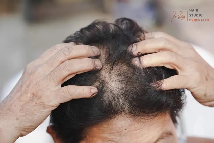 Alopecia Treatment Bakersfield Dermatologist Alopecia Treatment Bakersfield Dermatologist