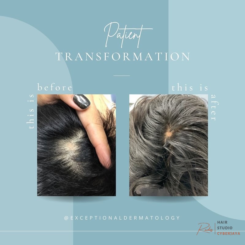Hair Loss | Exceptional Dermatology Care | Fullerton, CA Hair Loss | Exceptional Dermatology Care | Fullerton, CA