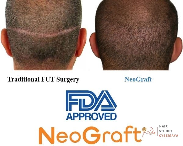 NeoGraft vs FUE by Hand A close-up of NeoGraft technology compared to manual FUE for hair transplants