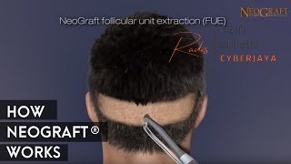 NeoGraft Hair Transplant: Benefits, Side Effects, How it Works NeoGraft Hair Transplant: Benefits, Side Effects, How it Works