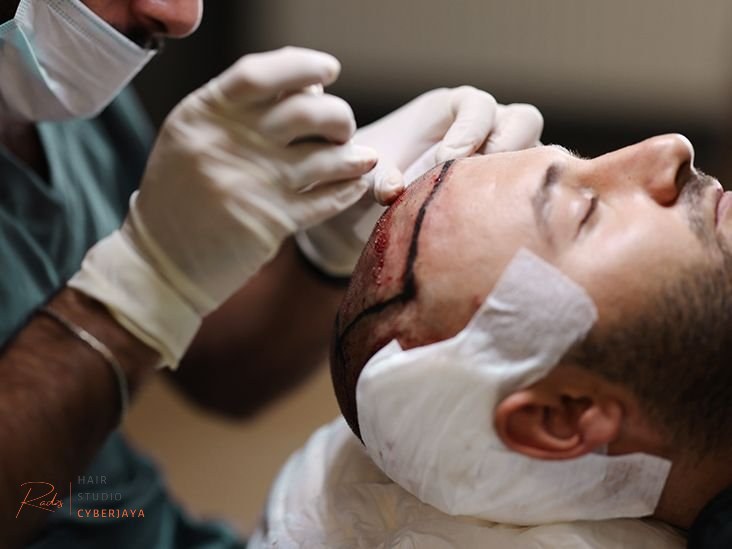 NeoGraft Hair Transplant: Benefits, Side Effects, How it Works Benefits, side effects, and how NeoGraft hair transplant works