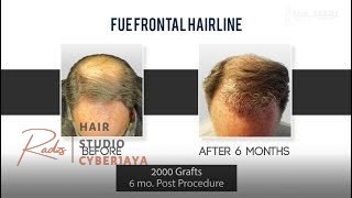 FUE vs. NeoGraft vs. ARTAS Ann Arbor, MI Comparison of FUE, NeoGraft, and ARTAS hair transplant methods in Ann Arbor, MI