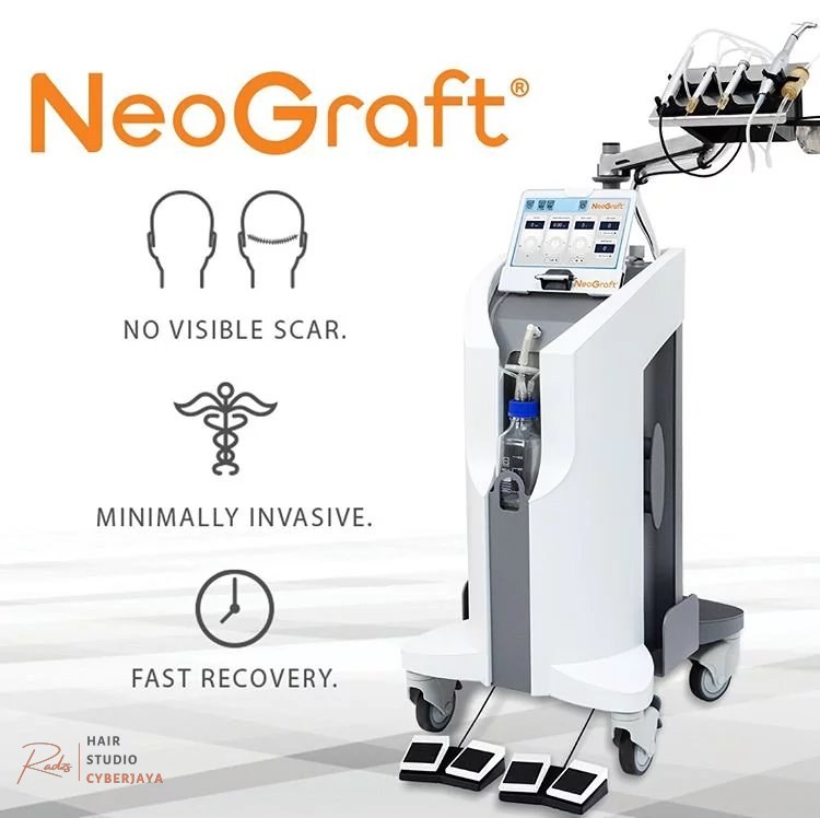 What is a Neograft Hair Transplant? What is a NeoGraft hair transplant? Understanding the procedure