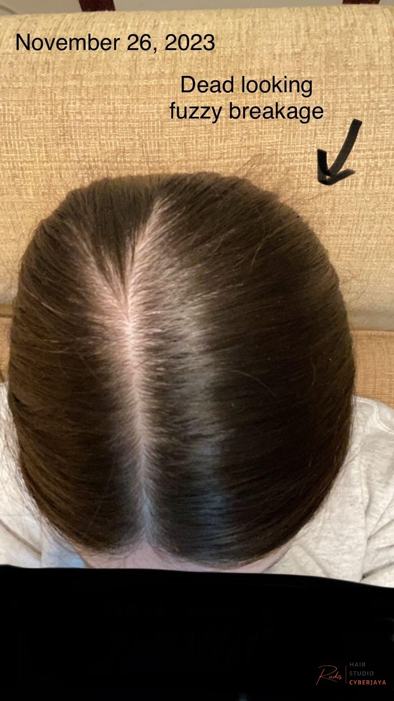 Finally ready to acknowledge what I believe really caused my hair loss. Adderall and Vaping. : r/FemaleHairLoss Finally ready to acknowledge what I believe really caused my hair loss. Adderall and Vaping. : r/FemaleHairLoss
