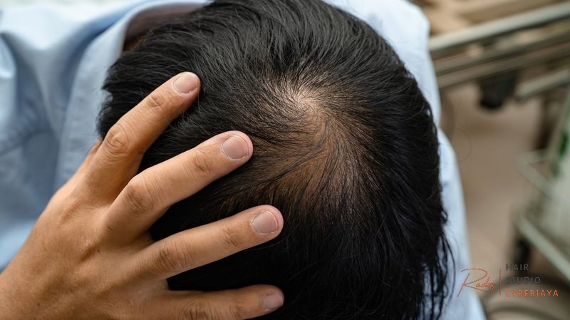 Does Vaping Cause Hair Loss Does Vaping Cause Hair Loss?