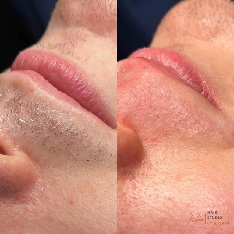 Electrolysis Permanent Hair Removal