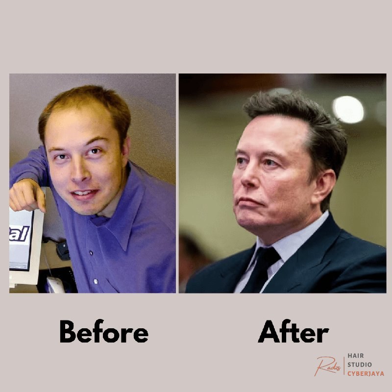 Elon Musk Hair Loss Treatment Evidence Did Elon Musk Get a Hair Transplant? The Evidence Explained – Dr. Mehmet Yıldıran