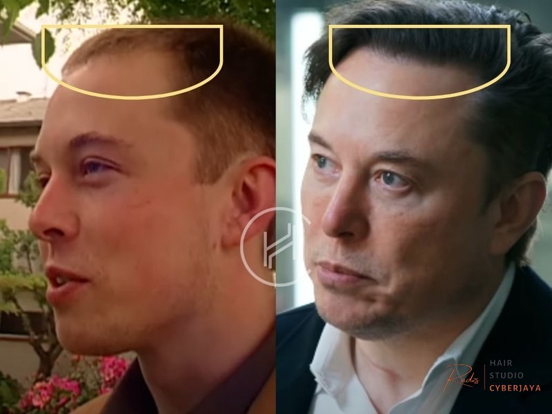 Elon Musk Hair Transplant Before and After Analysis Elon Musk Hair Transplant - Hair Loss Analysis with Photos
