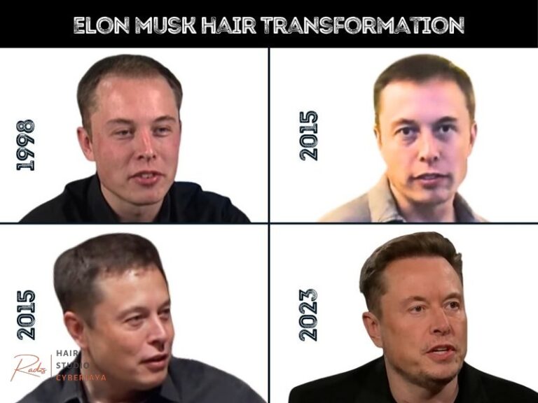 Elon Musk Hair Transplant - Hair Loss Analysis with Photos