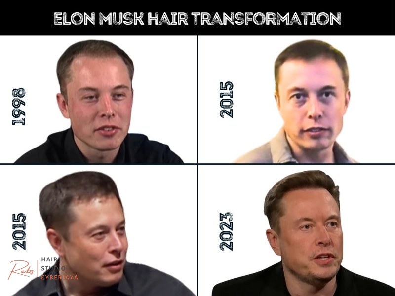 Elon Musk Hair Transplant Transformation Photos Elon Musk Hair Transplant - Hair Loss Analysis with Photos
