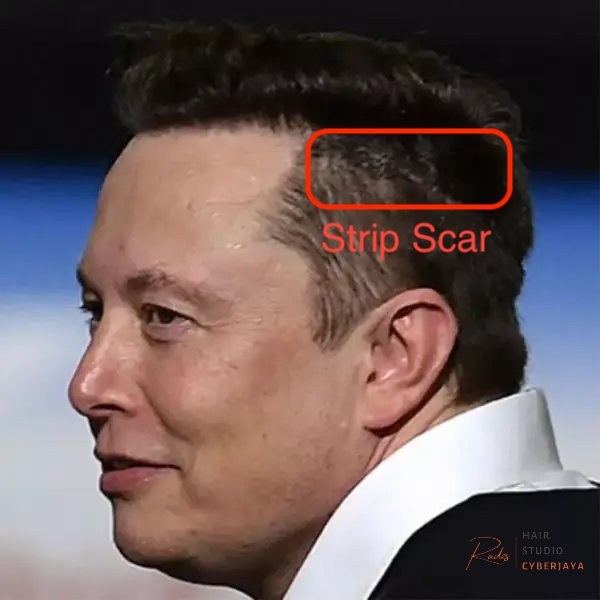 Elon Musk Hair Transplant Scar and Graft Count Elon Musk Hair Transplant: How Many Grafts Did He Need? | Este Quality