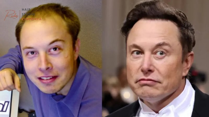 Elon Musk Hair Transplant: Timeline, Cost & Expert Analysis Elon Musk Hair Transplant: Timeline, Cost & Expert Analysis