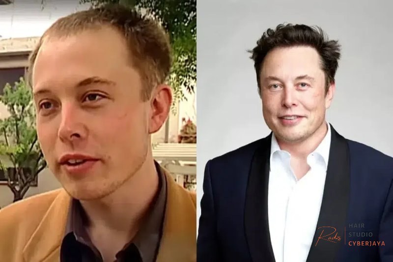 Elon Musk Hair Transplant: How Many Grafts Did He Need? | Este Quality Elon Musk Hair Transplant: How Many Grafts Did He Need? | Este Quality