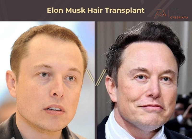 Elon Musk Hair Transplant - Hair Transplant Turkey Dr Resul Yaman Elon Musk Hair Transplant - Hair Transplant Turkey Dr Resul Yaman