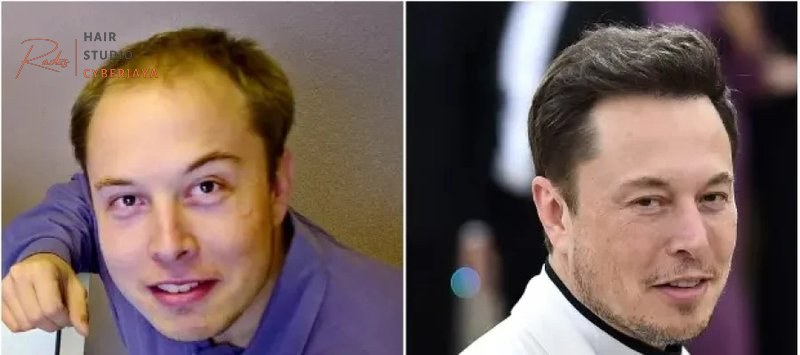 Elon Musk Hair Transplant Technique and Procedure - Best Hair Transplant Clinic in Turkey Elon Musk Hair Transplant Technique and Procedure - Best Hair Transplant Clinic in Turkey