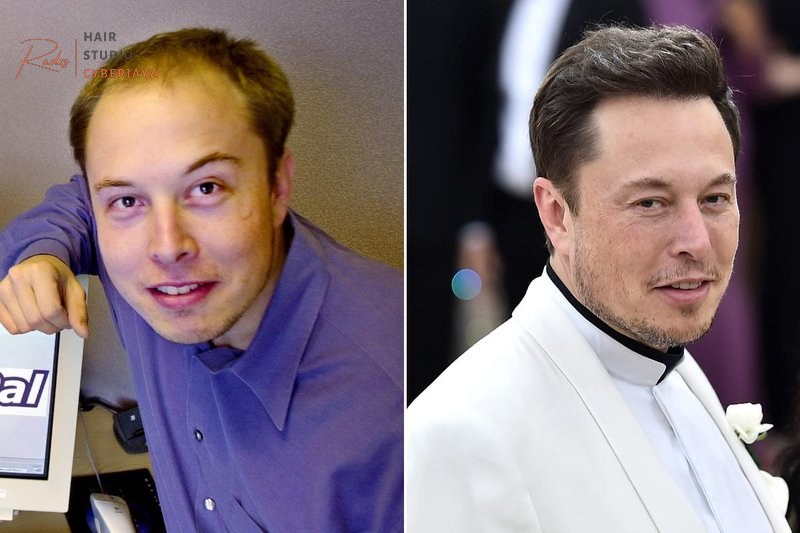 Elon Musk Hair Transplant Cost Estimate It's 'highly likely' Elon Musk spent over $20K on hair transplant surgery, doctor says