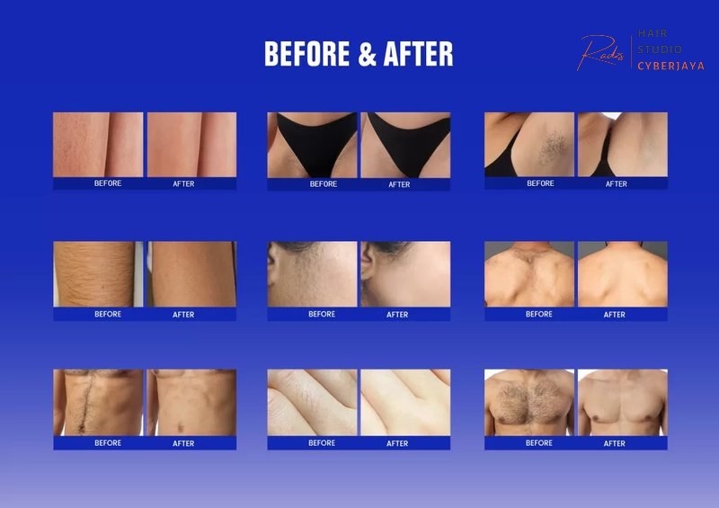 Full Body Laser Hair Removal Before and After How Much Does Full Body Laser Hair Removal Cost? - PZLASER