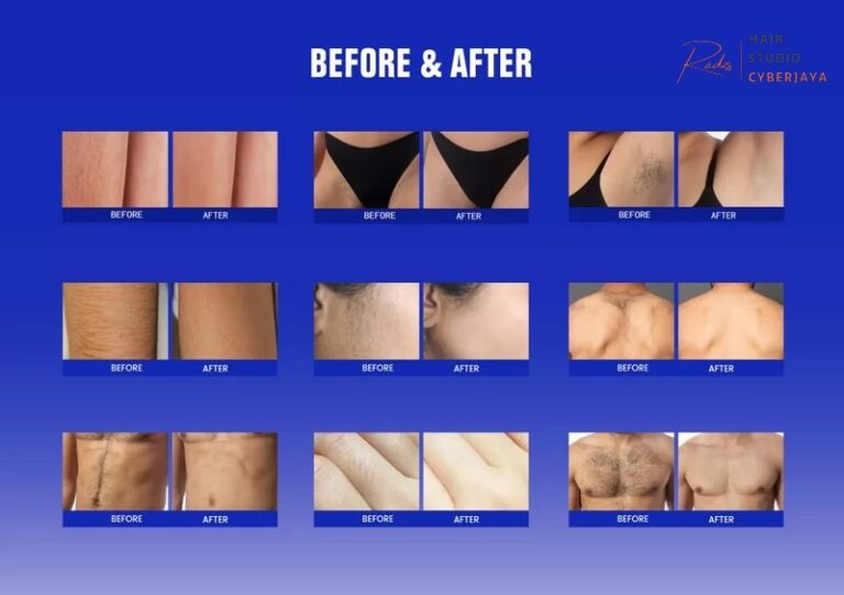 How Much Does Full Body Laser Hair Removal Cost? - PZLASER