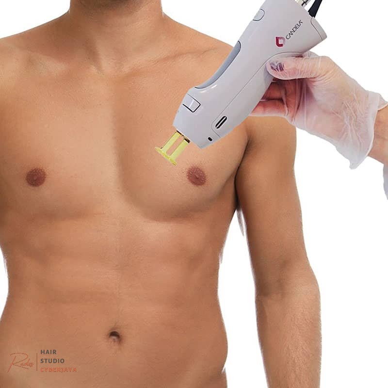 Modern laser hair removal clinic Chest & Back Laser Hair Removal Boca Raton | IconMD